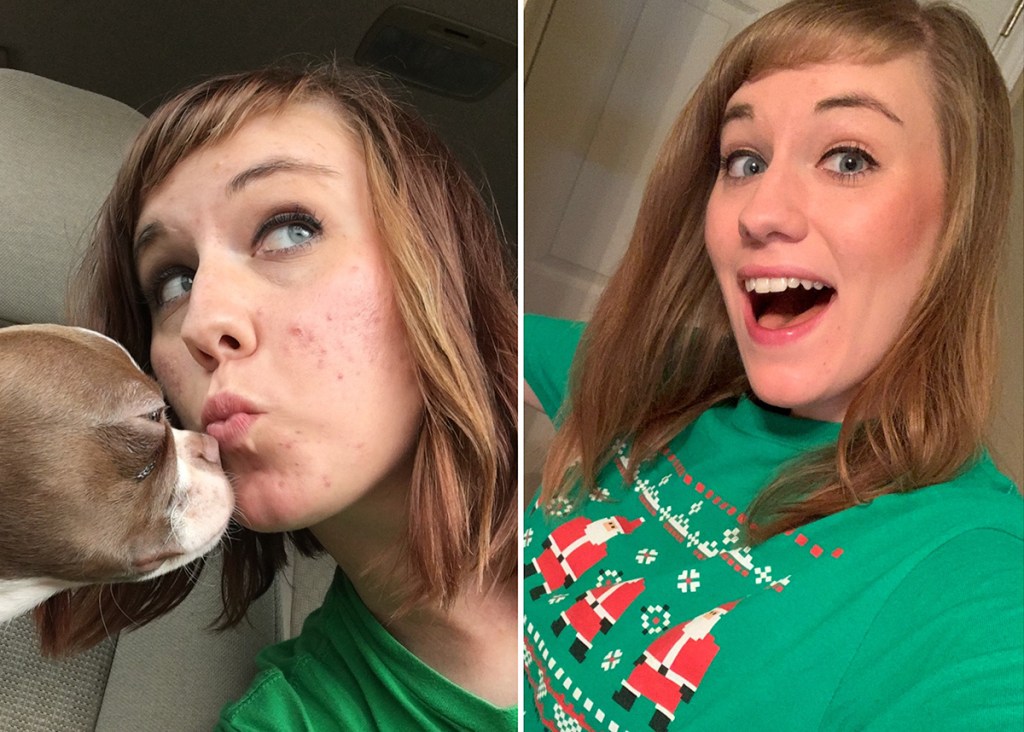 amanda side by side image showing acne clearing up